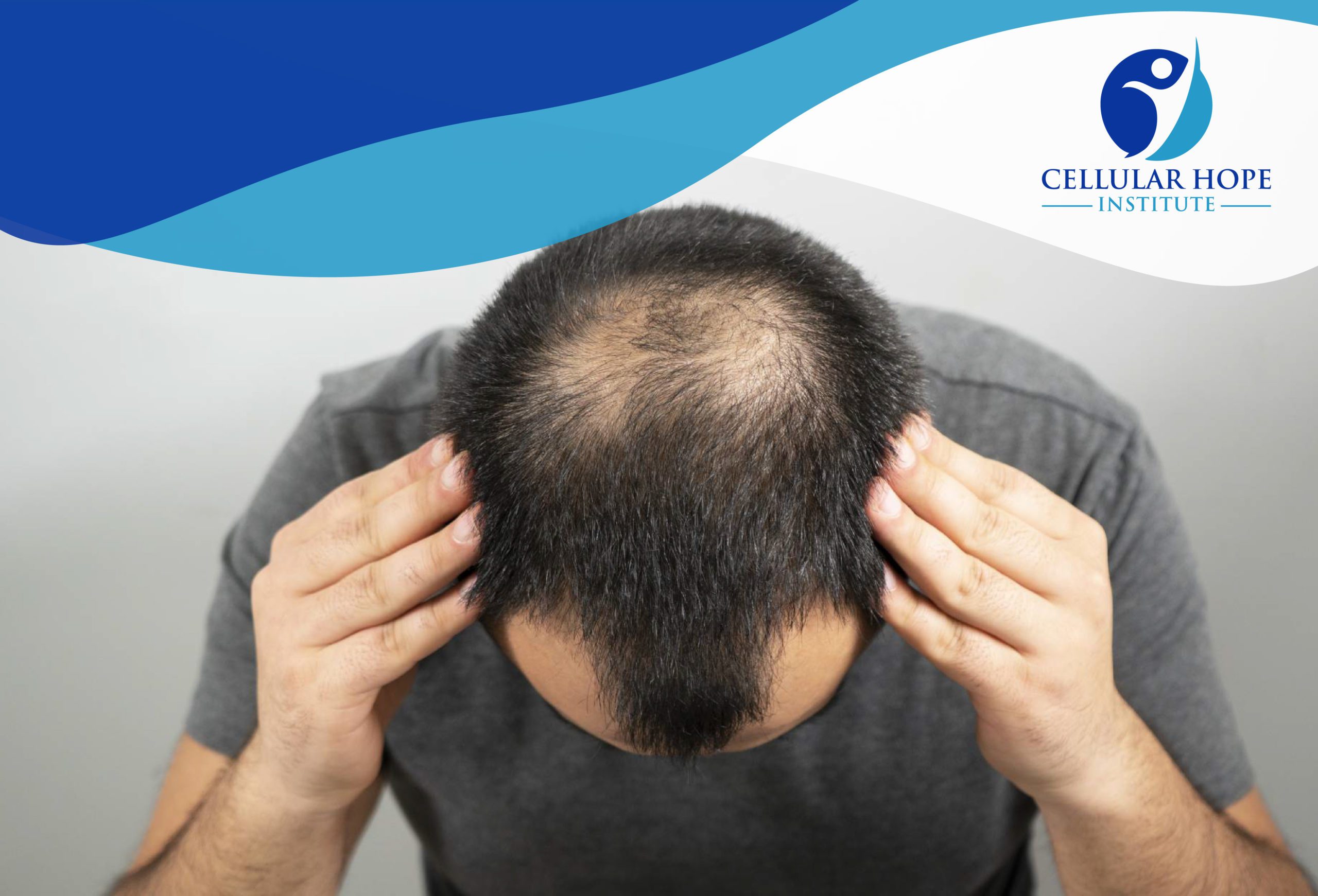 Can Stem Cell Therapy Help With Alopecia (hair loss)?