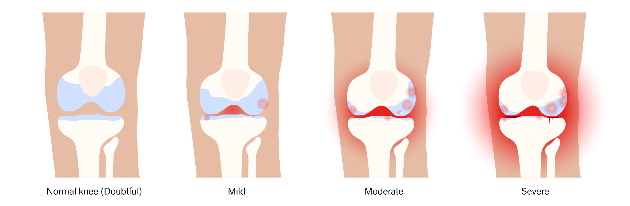 stages of arthritis