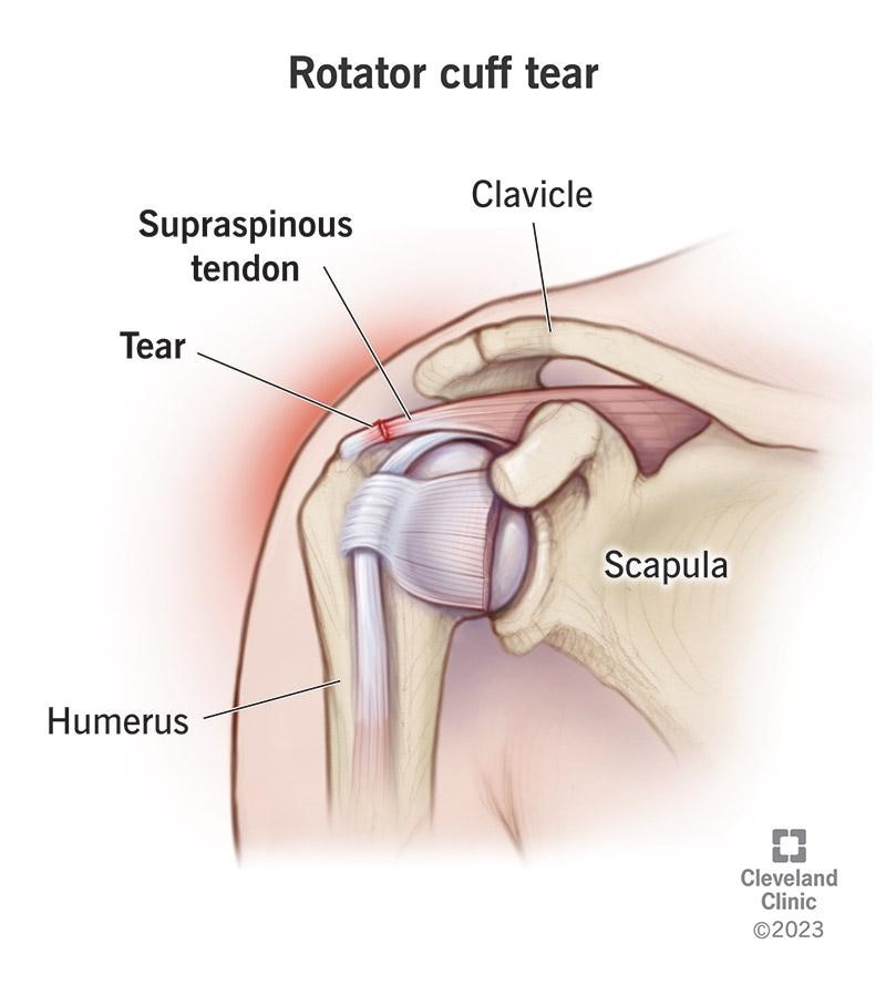 rotator cuff tear - Is Stem Cell Shoulder Treatment Effective? Top 5 Factors