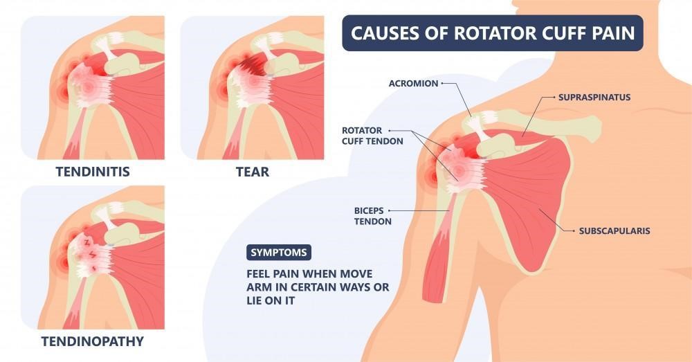 What Is The Recovery Time of Stem Cell Therapy For Shoulders?